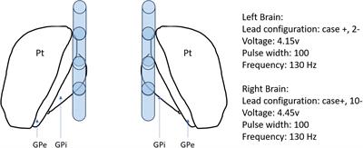 Case report: Approaches to treatment-refractory and super-refractory glutamic acid decarboxylase antibody-spectrum disorders